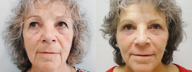 Rejuvenecimiento Facial fotos antes y después 5