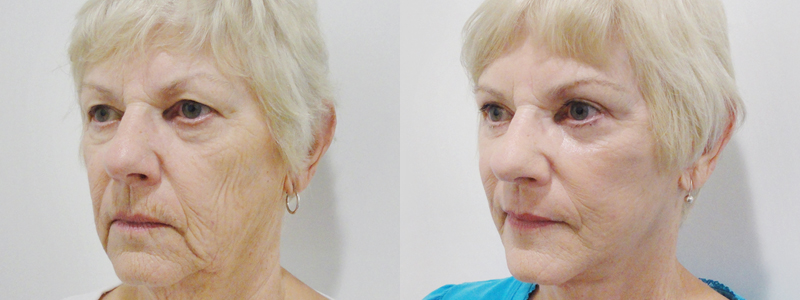 Rejuvenecimiento Facial fotos antes y después 4