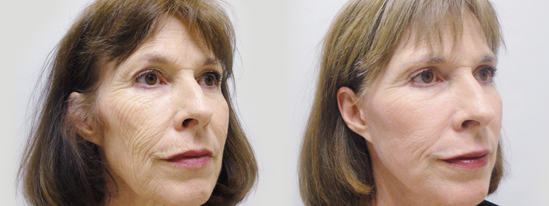 Rejuvenecimiento Facial fotos antes y después 1